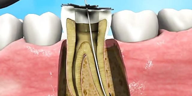Diş kökü iltihabı kötü sonuçlar doğurabilir