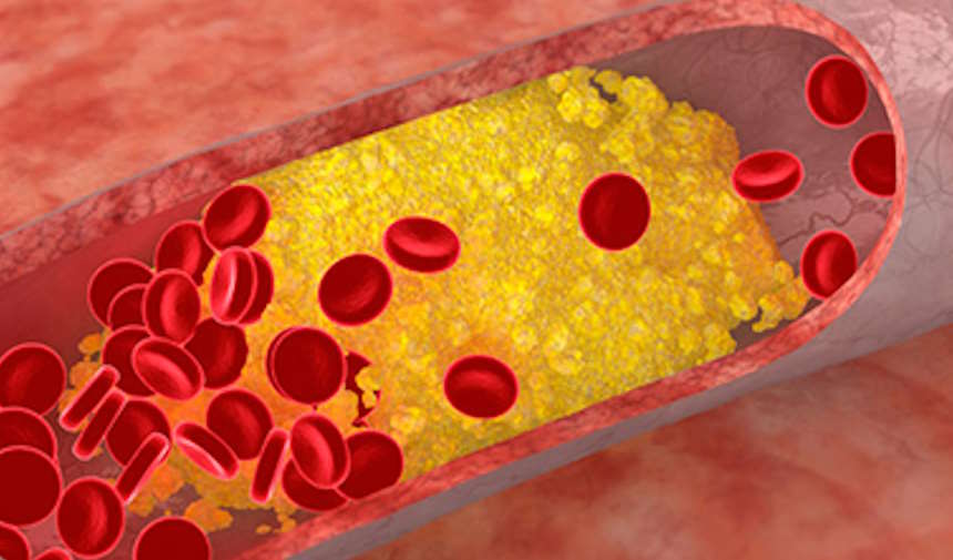 kolesterol-nasil-duser