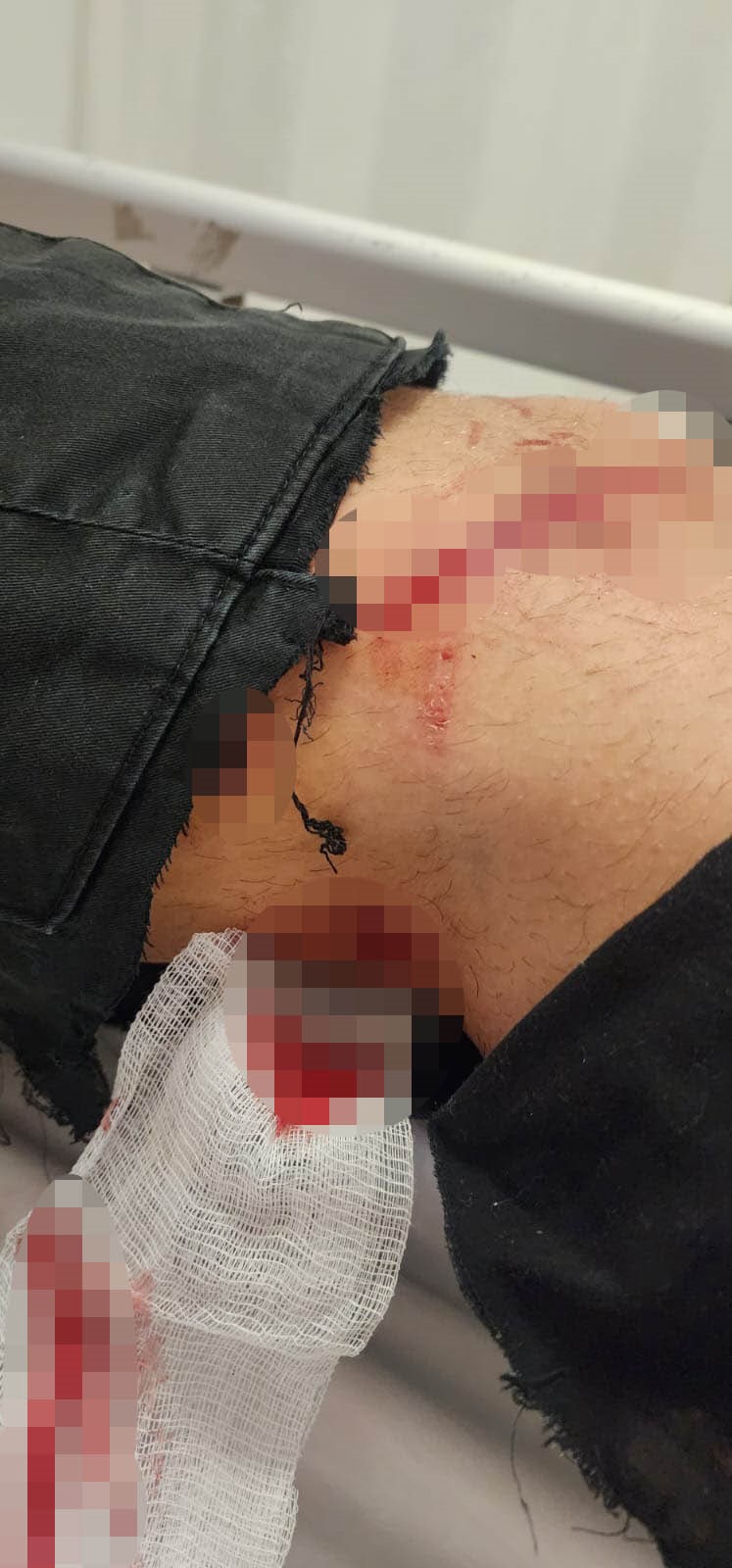 Köpek saldırısına uğrayan çocuğun ailesi, Çankaya Belediyesine dava açmaya hazırlanıyor (6)