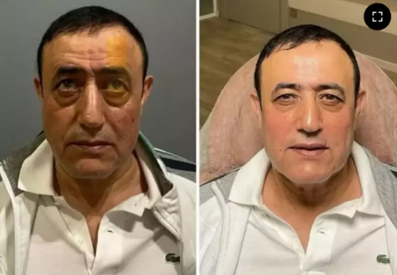 Mahmut Tuncer’de Estetik Kervanına Katıldı! İşte Yüzündeki O Değişim (1)